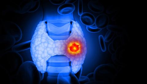 news 4 luglio - Termoablazione con radiofrequenza nella metastasi linfonodale tiroidea